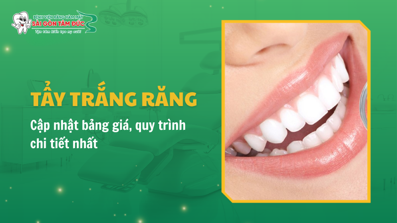 Tẩy trắng răng là gì? Cập nhật bảng giá, quy trình chi tiết nhất 2026