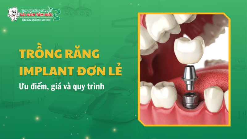 Trồng răng Implant đơn lẻ là gì? Ưu điểm, giá và quy trình 2026