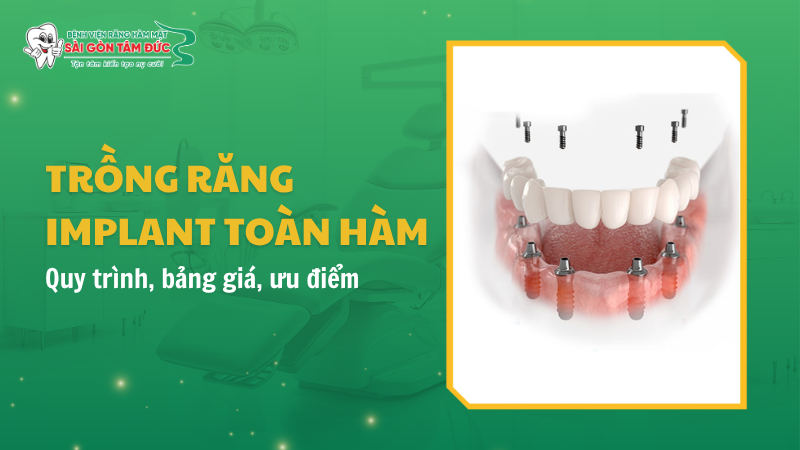 Trồng răng Implant toàn hàm: Quy trình, bảng giá, ưu điểm 2026