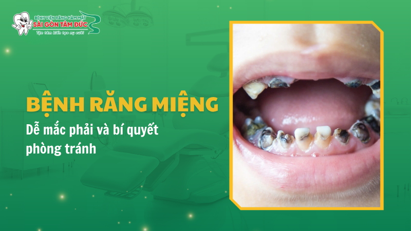 17+ bệnh răng miệng thường gặp dễ mắc phải và bí quyết phòng tránh