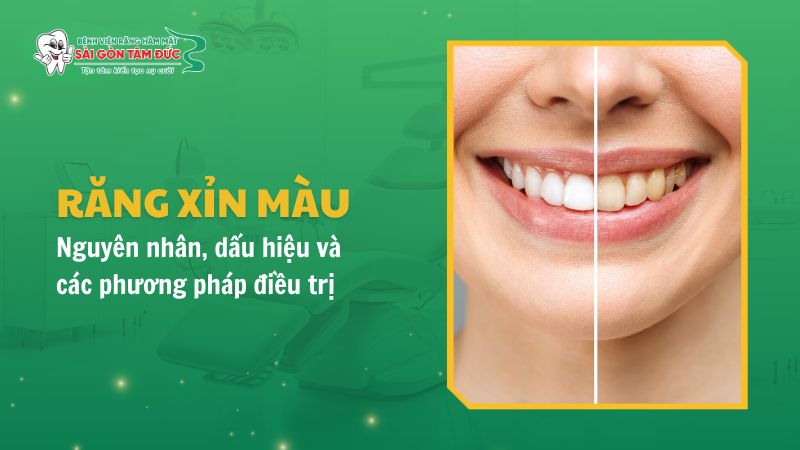 Răng xỉn màu: Nguyên nhân, dấu hiệu và các phương pháp điều trị