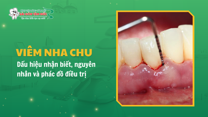 Bệnh viêm nha chu: Dấu hiệu nhận biết, nguyên nhân và phác đồ điều trị hiệu quả